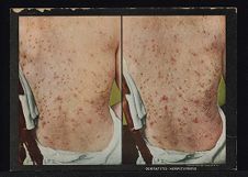 Dermatitis Herpetiformis