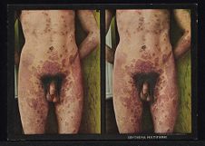 Erythema Multiforme