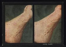 Lichen Planus