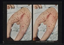 Syphilis Hereditaria