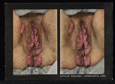 Syphilis Secundaria