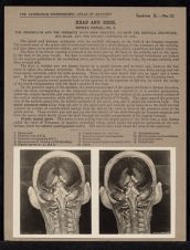 Head and Neck. Spinal Canal - no. 3