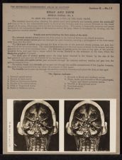 Head and Neck. Spinal Canal - no. 4