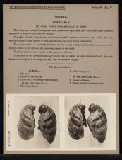 Thorax. Lungs - no. 1