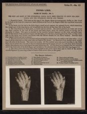 Upper Limb. Palm of Hand - no. 1