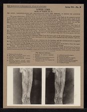 Lower Limb. Back of Thigh - no. 2