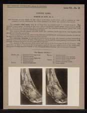 Lower Limb. Dorsum of Foot - no. 3