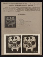 Vertical Transverse Bilateral Section - no. 6