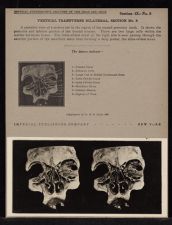 Vertical Transverse Bilateral Section - no. 8