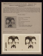 Vertical Transverse Bilateral Section - no. 10