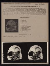 Vertical Transverse Bilateral Section - no. 11