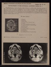 Development of the External Auditory Canal - no. 3