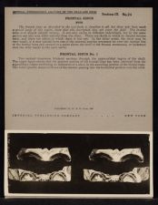 Frontal Sinus - Note & no. 1