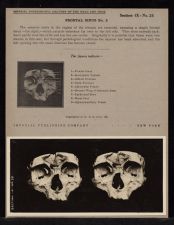 Frontal Sinus - no. 2