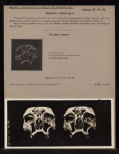 Frontal Sinus - no. 5