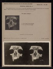 Frontal Sinus - no. 6