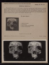 Frontal Sinus - no. 7