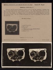 Frontal Sinus - no. 8