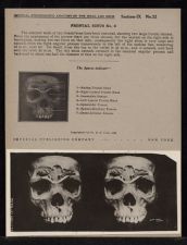 Frontal Sinus - no. 9