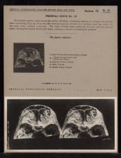 Frontal Sinus - no. 10