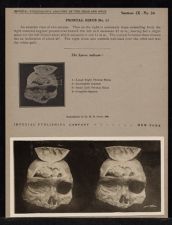 Frontal Sinus - no. 11