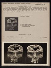 Frontal Sinus - no. 12