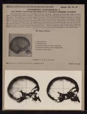 Stereoscopic Radiogram - no. 2