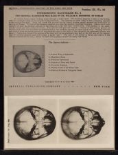 Stereoscopic Radiogram - no. 3