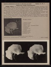 Temporal Bone Topography