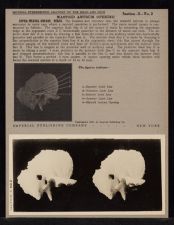 Mastoid Antrum Opening