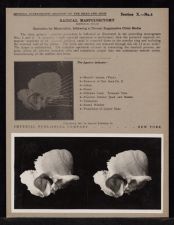 Radical Mastoidectomy