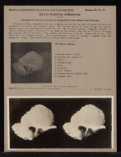 Meato Mastoid Operation