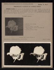 Descending Portion of Lateral Sinus