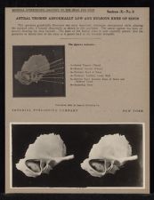 Antral Tegmen Abnormally Low and Bulbous Knee of Sinus