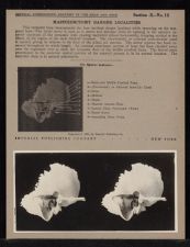 Mastoidectomy Danger Localities