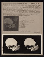 Relation of Descending and Transverse Facial Nerve to Horizontal or External Semicircular Canal and Oval Window