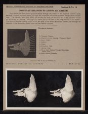 Ossicular Relation to Aditus Ad. Antrum