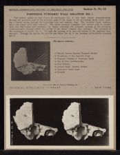 Posterior Tympanic Wall Relation - no. 1