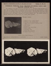 Posterior Tympanic Wall Relation to Facial Canal and Mastoid Antrum - no. 2