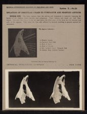 Relation of Ossicular Chain to Tympanum and Mastoid Antrum