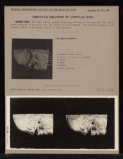 Ossicular Relation to Annular Ring