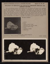 Relation of Semicircular Canals to Tympanum Ossicles and Mastoid Process