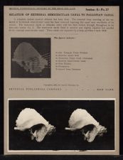 Relation of External Semicircular Canal to Fallopian Canal