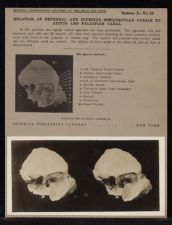 Relation of External and Superior Semicircular Canals to Aditus and Fallopian Canal