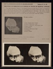 Relation of Semicircular Canals to Floor of Mastoid Antrum