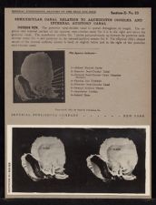 Semicircular Canal Relation to Aqueductus Cochlea and Internal Auditory Canal