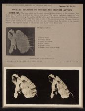 Cochlea Relation to Ossicles and Mastoid Antrum