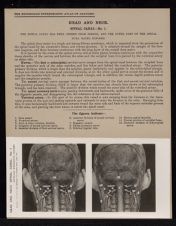 Head and Neck. Spinal Canal - no. 1